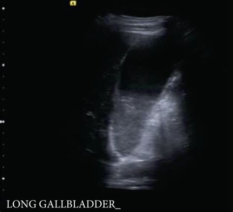 Abdominal Ultrasound Revealing Dilated Common Bile Duct Measuring A