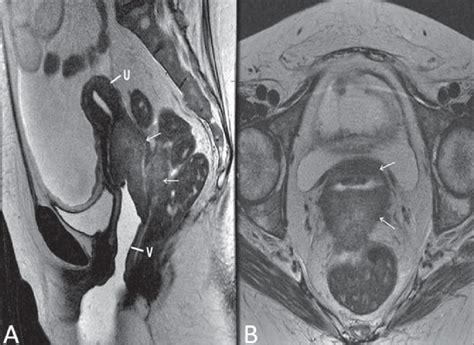 Uterine Cervix Adenocarcinoma With Locally Invasive Tumor Sagittal A