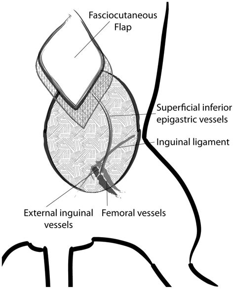 A Diagram Of Lower Left Inguinal Anatomic Landmarks Of Flap With