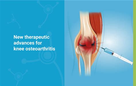 Osteoarthritis Knee