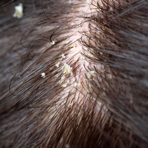 Forfora Nei Capelli Cuoio Capelluto A Fiocchi Fotografia ...