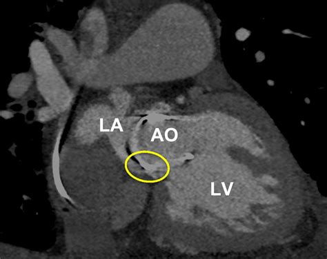 Aorto Left Atrial Fistula Diagnosed With Computed Tomographic