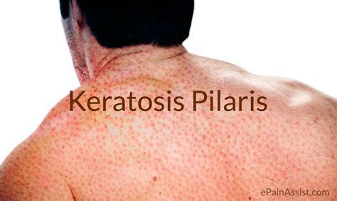 Keratosis Pilaris Kp Causes Symptoms Treatment Home Remedies