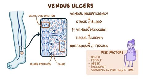 Pathophysiology Of Venous Ulcers