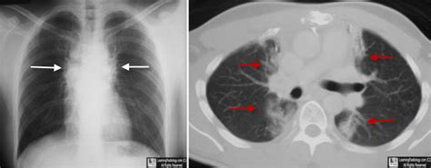 Learningradiology Radiation Fibrosis Pneumonitis