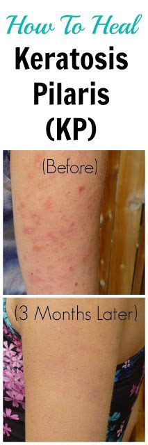 Keratosis Pilaris Forehead Treatment Anti Aging And Young