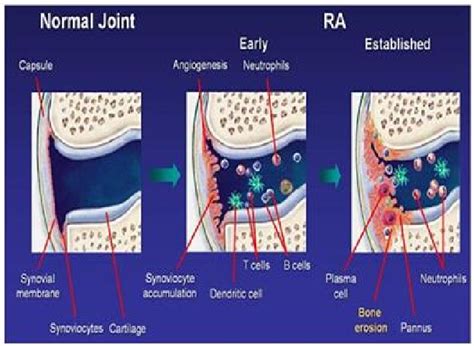 Pdf Rheumatoid Arthritis Pathophysiology Animal Models And Herbal