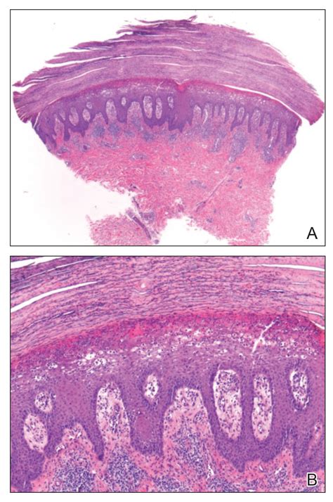 Rupioid Psoriasis And Psoriatic Arthritis In A Patient With Skin Of