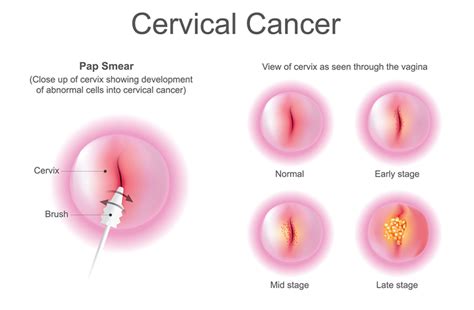 We did not find results for: Ujian Pap Smear Terbaru, Kini Tiada Lagi 'Muncung Itik ...