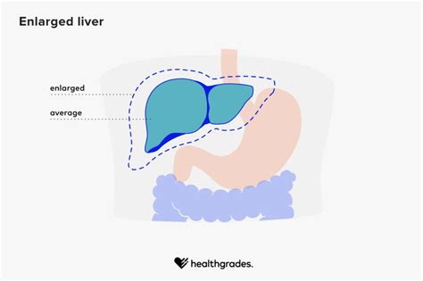 Enlarged Liver Symptoms Causes And Treatments