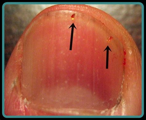 What Are The Symptoms Of Mite Infestation In Humans Mccnsultingweb