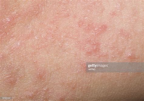 Red Skin Rash With Bumps Scabs Pimples On Child Stockfoto Getty Images