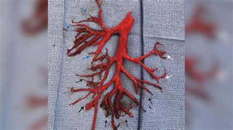 Man Coughs Up Blood Clot In Perfect Shape Of Bronchial Tree Abc7 Los
