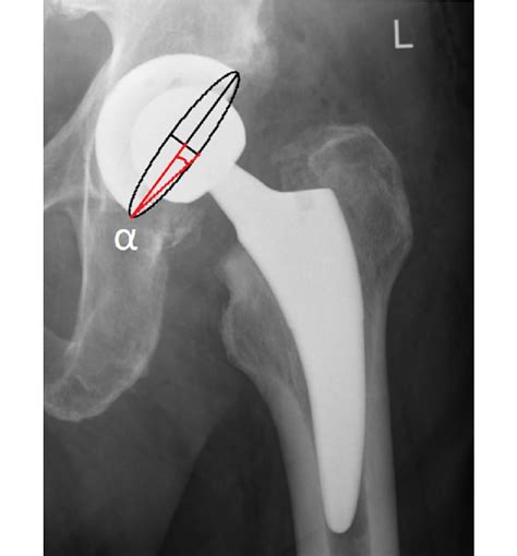 Liaws Acetabular Anteversion Measurement α An Angle Between The