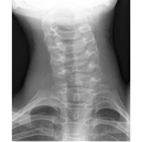Pdf Solid Variant Of Aneurysmal Bone Cyst On The Cervical Spine Of A