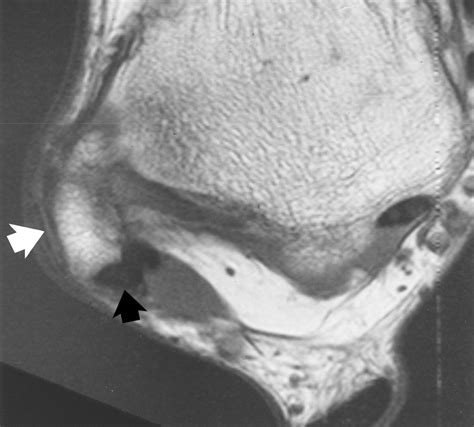 Mri Features Of Chronic Injuries Of The Superior Peroneal Retinaculum Ajr