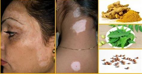 How To Get Rid Of White Patches On Skin Easily Entertainment News