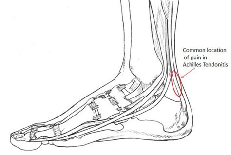 Achilles Tendonitis Footeducation