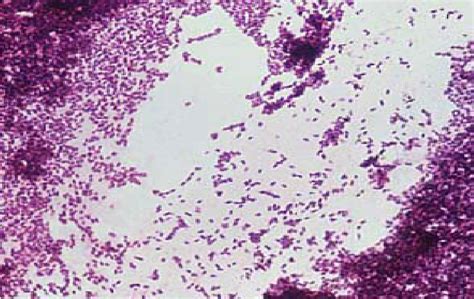 Listeria monocytogenes is a gram positive bacterium that causes listeriosis. Listeria monocytogenes Gram Stain as seen in a light ...