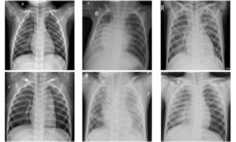 Machine Learning Framework Classifies Pneumonia On Chest X Rays
