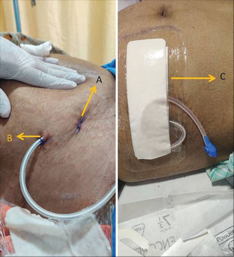 Management Of Malignant Ascites By Indwelling Tunnelled Catheters In