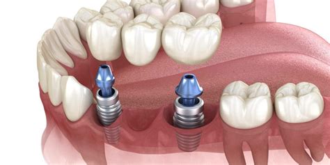 Por qué es tan exitoso el implante dental de titanio V de la Clínica