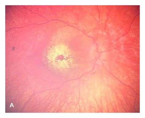 Retcam Images A Right Eye B Left Eye Bilateral Optic Disc