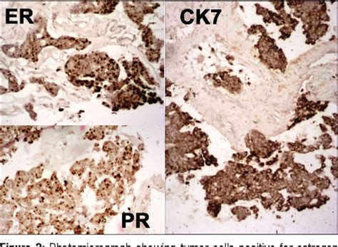 Primary Mucinous Eccrine Carcinoma Of Axillary Skin Report Of A Rare