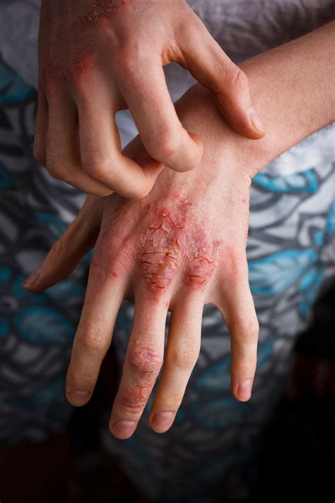 Hand Eczema About And Treatments Eczema Org