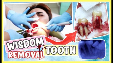 Wisdom Tooth Removal Process Extraction Surgery Purpleheiress Youtube