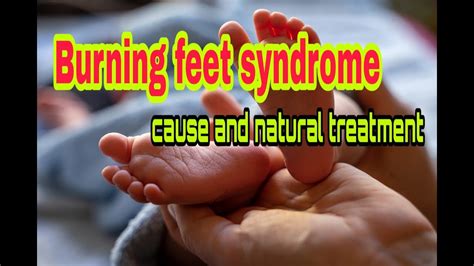 Burning Feet Syndrome पैर के तलुओं मे जलन Cause And Treatment In Hindi Youtube