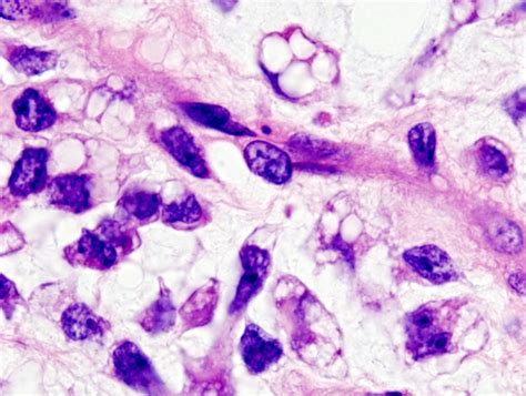 Liposarcoma Bien Diferenciado Femexer