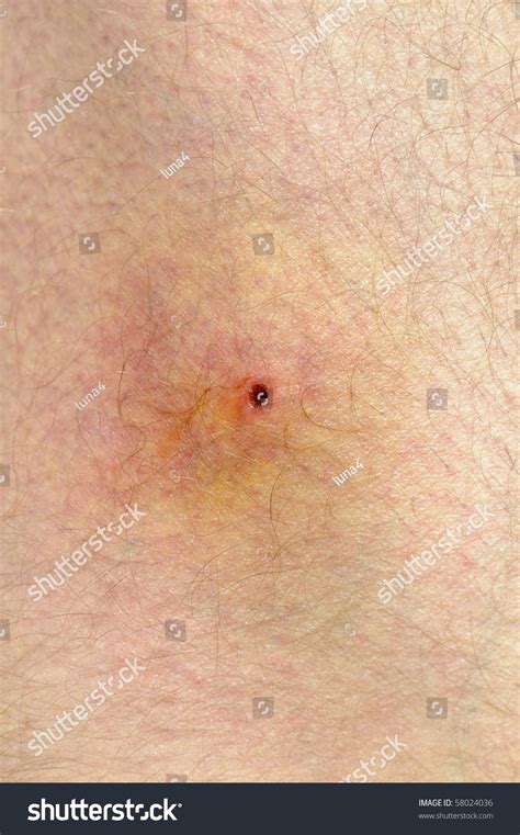Infected Tick Bite On Thigh Stock Photo 58024036 Shutterstock
