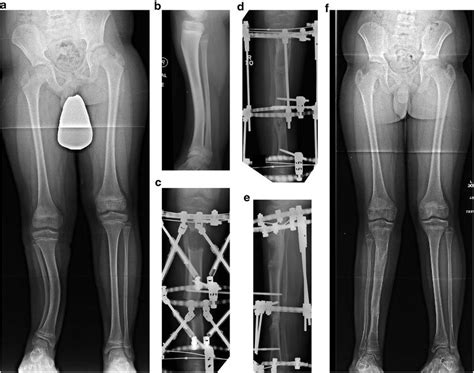 Decision Making In Lower Extremity Deformity Correction Obgyn Key