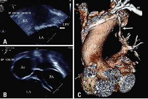 Transesophageal Echocardiography Bicaval View Of The Patient A Download Scientific Diagram