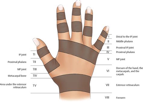 Zones Of Extensor Tendon Injuries Plastic Surgery Key