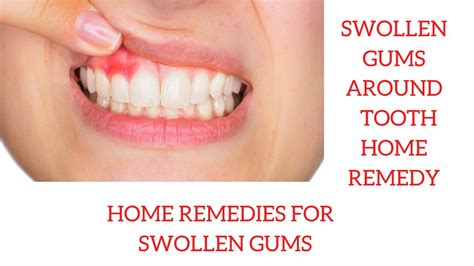 Swollen Gums Around Tooth Home Remedy Home Remedies For Swollen Gums