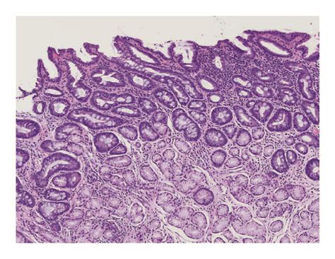 Endoscopic And Histologic Appearance Of Gastrointestinal Metaplasia In