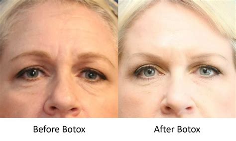 Frown Lines Botox Before And After