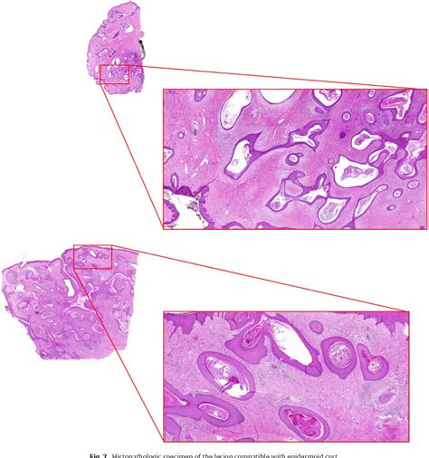 Figure 1 From Unusual Presentation Of Epidermoid Cyst Mimicking Breast