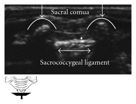 placing the probe transverse plane at the coccyx the sacral cornua download scientific diagram
