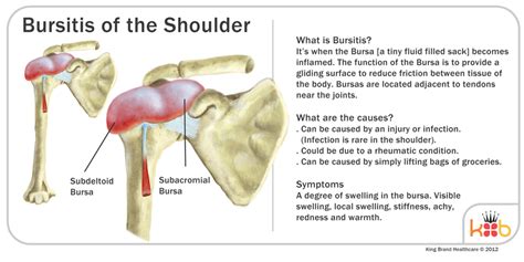 It is a thin, flat sac made of fibrous connective tissue frequent movement of the deltoid can cause irritation of the subdeltoid bursa, leading to a painful condition known as bursitis. King Brand Shoulder Images