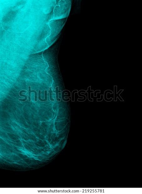 Woman Right Breast Xray Closeup Vertical Stock Photo