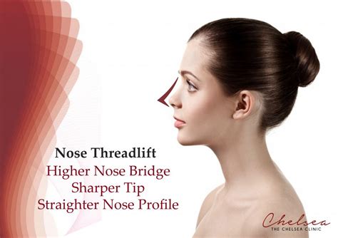 The thread lift procedure does not involve hospitalization, anesthesia, or a long recovery period. Nose Threadlift | The Chelsea Clinic