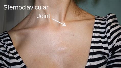Sternoclavicular Joint Dislocation Physical Therapy And Treatment
