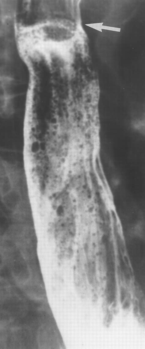 The Foamy Esophagus A Radiographic Sign Of Candida Esophagitis AJR