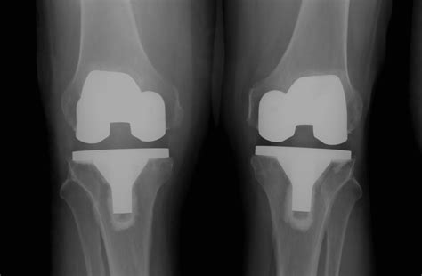 Knee Surgery Update Robert Howells