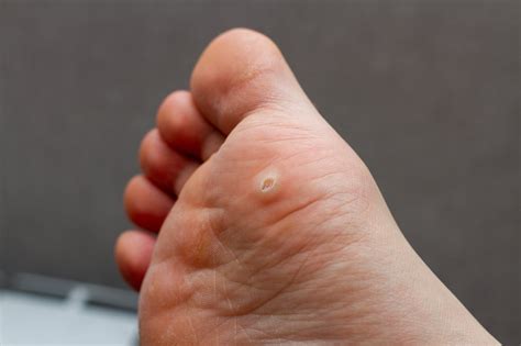 The 10 Minute Rule For Warts And Plantar Warts Cigna