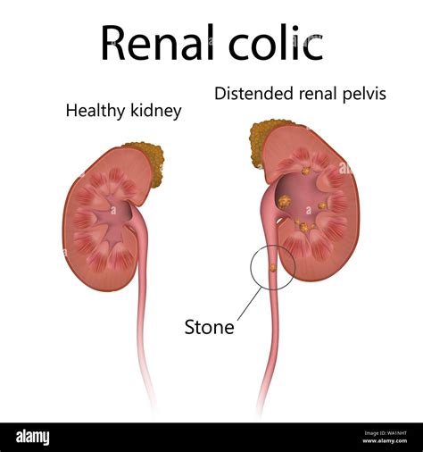 Nierenkolik Stockfotos Und Bilder Kaufen Alamy
