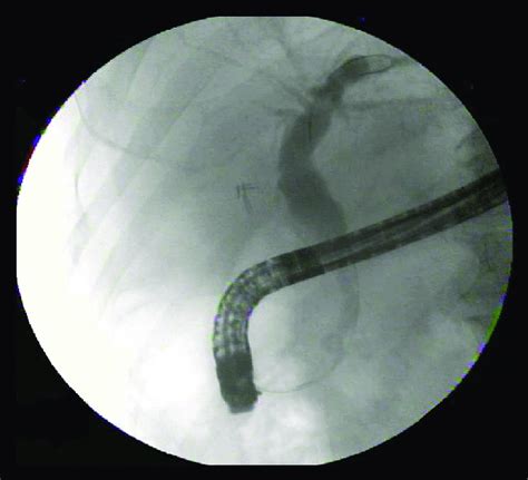 Ercp Demonstrating A Smooth 3 Cm Long Tapering Stricture Of The